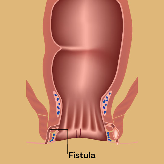 भगन्दर (Fistula)