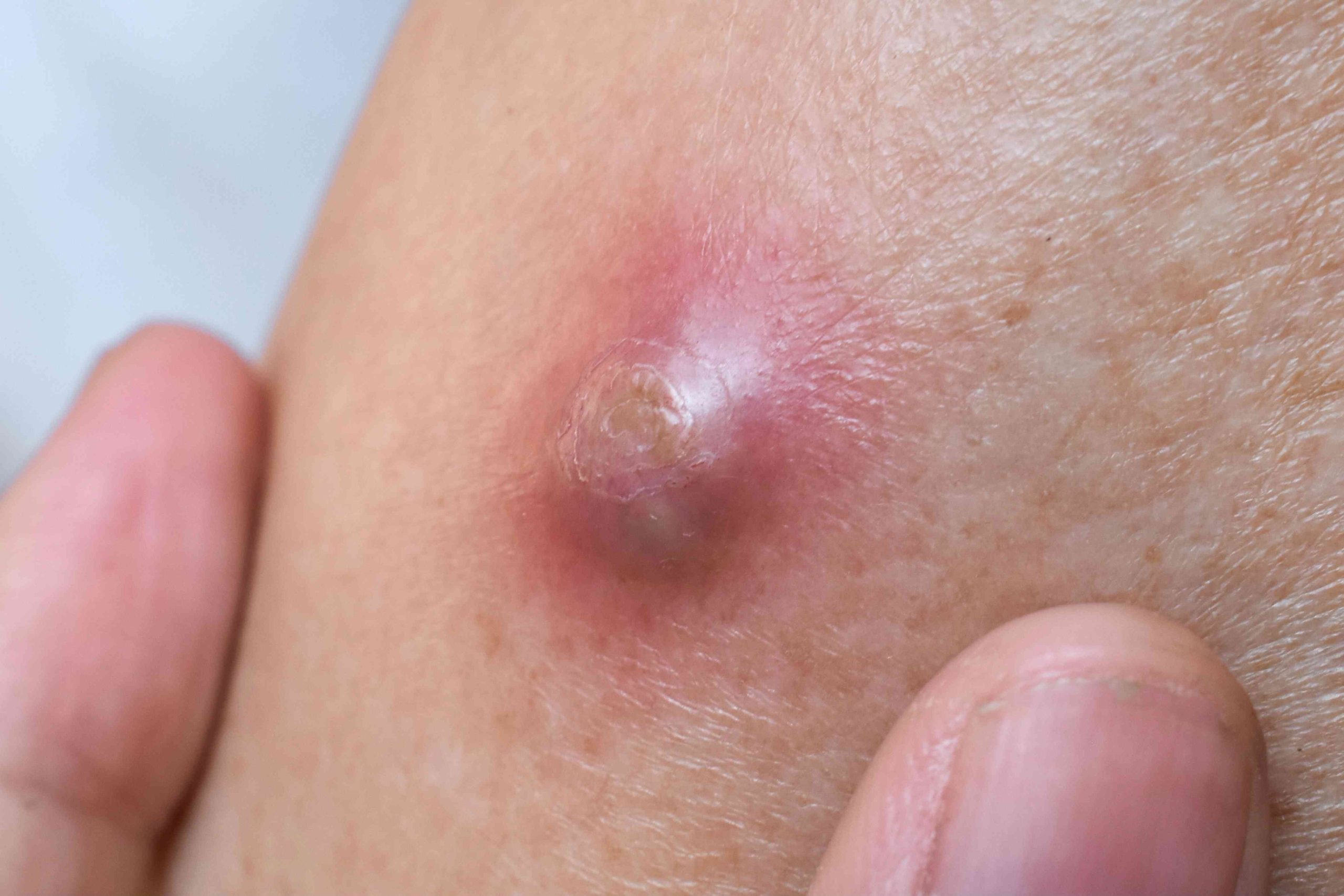 फोड़ा (Abscess)