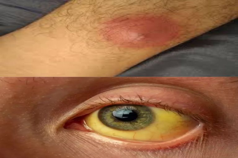 बालतोड़ और पीलिया