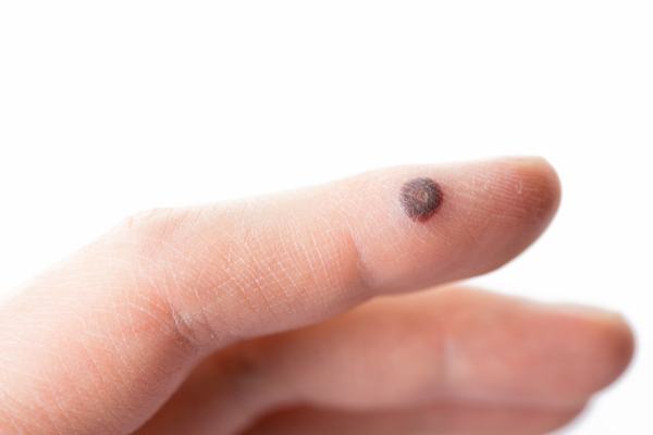 काले मस्से (Black warts)