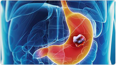 कैंसर (Cancer)