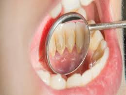 दांतों की बीमारिय में रामबाण