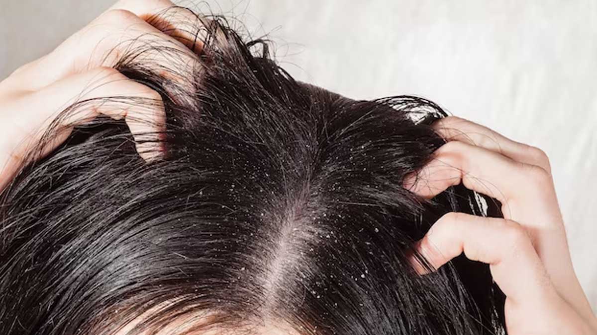 सिर की खुश्की (Dryness of scalp)