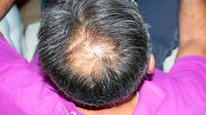 बालों का गिरना (Hair Falling)