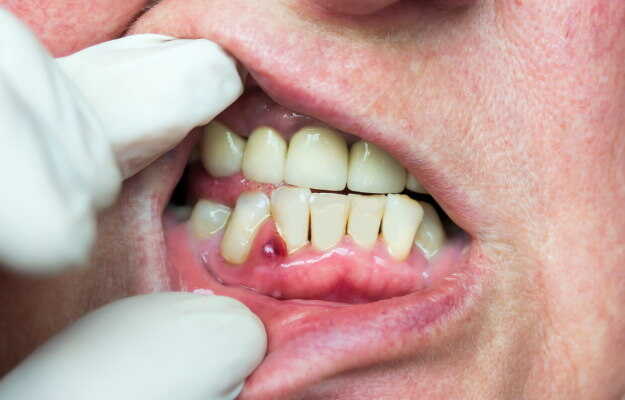 मसूढ़ों में सूजन तथा घाव (Gum inflammation and wound)