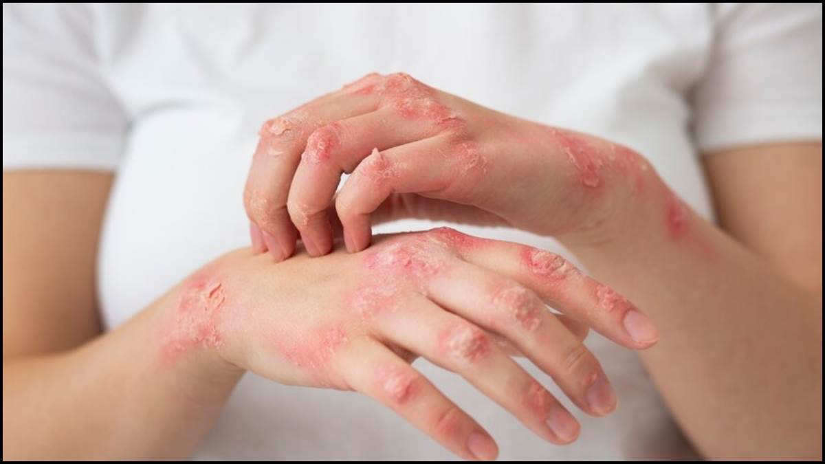 कुष्ठ (Leprosy)