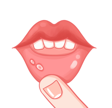 मुँह के छाले