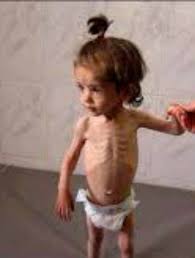 सूखा रोग (Rickets)