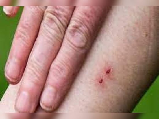 सर्पदंश (Snake bite)