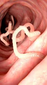 पेट में कृमि (पेट में कीड़े) (Stomach worm)