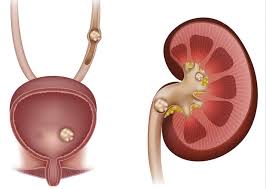 मूत्राशय और वीर्यशय की पथरी (Bladder stone)