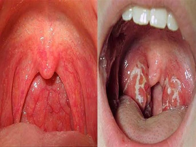गले के रोग (Throat Diseases)