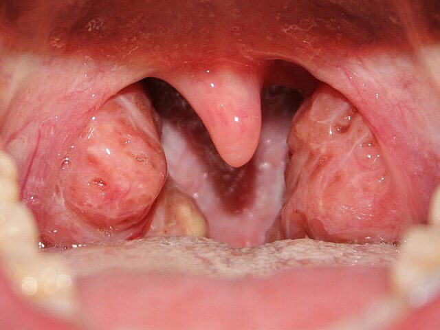 कण्ठमाला (Tonsillitis)