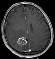 मांसवृद्धि (Tumour)